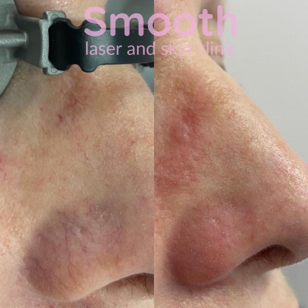 Better Skin in Burton-on-Trent | Smooth Laser and Skin Clinic gallery image 9