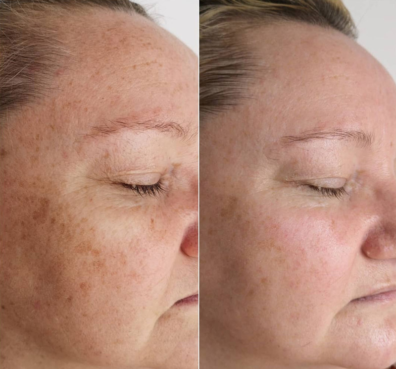 Better Skin in Burton-on-Trent | Smooth Laser and Skin Clinic gallery image 5