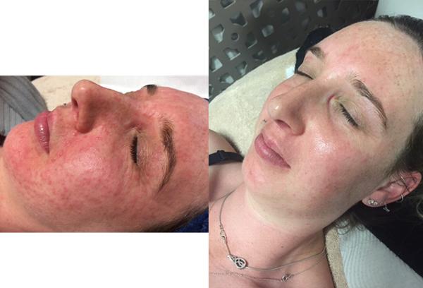 Laser Hair Removal in Burton-on-Trent and Skin rejuvenation